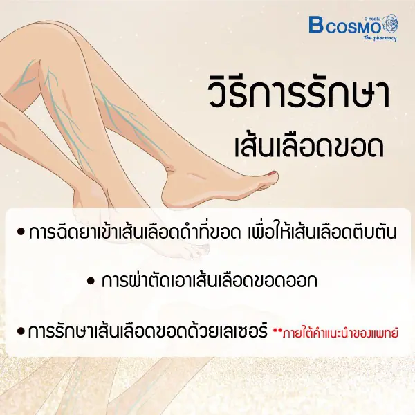 ภัยรายใกล้ตัว อาการเส้นเลือดขอด เกิดจากอะไรได้บ้าง ภัยรายใกล้ตัว อาการเส้นเลือดขอด เกิดจากอะไรได้บ้าง