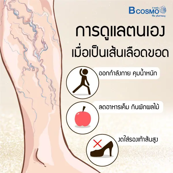 ภัยรายใกล้ตัว อาการเส้นเลือดขอด เกิดจากอะไรได้บ้าง ภัยรายใกล้ตัว อาการเส้นเลือดขอด เกิดจากอะไรได้บ้าง