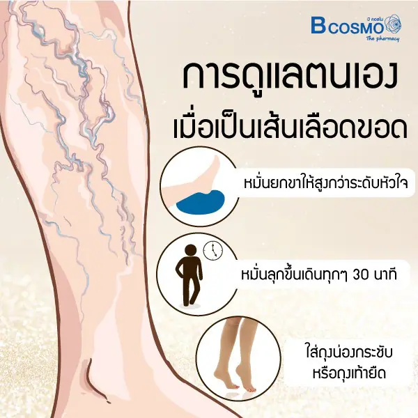ภัยรายใกล้ตัว อาการเส้นเลือดขอด เกิดจากอะไรได้บ้าง ภัยรายใกล้ตัว อาการเส้นเลือดขอด เกิดจากอะไรได้บ้าง