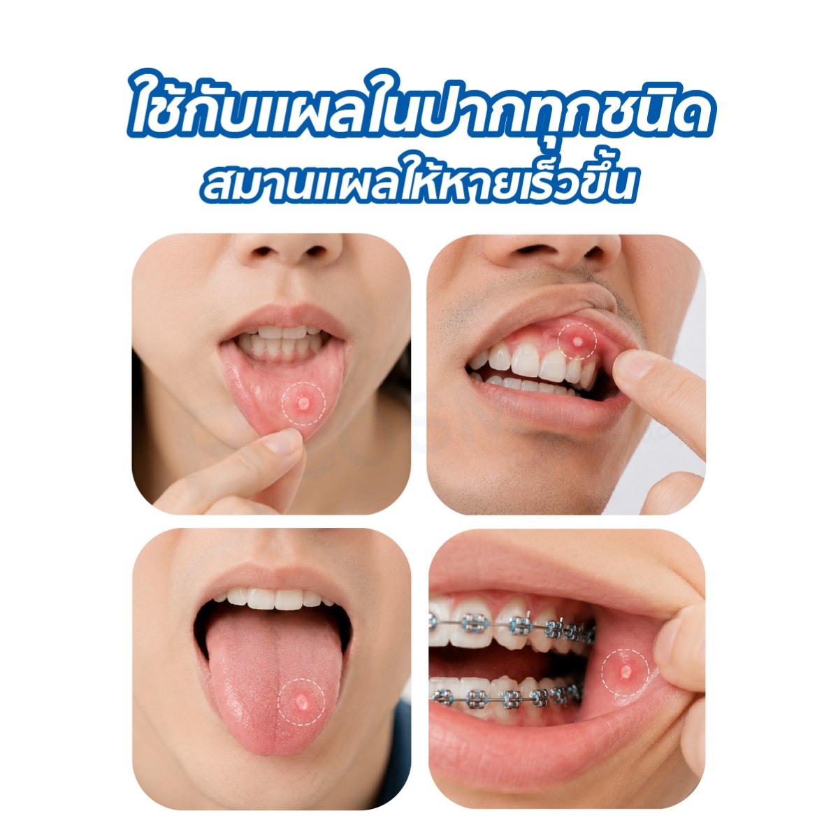 แผ่นปิดแผลในปาก Time Oral Ulcer Patch 1.5 cm. 6 ชิ้น แผ่นปิดแผลในปาก Time Oral Ulcer Patch 1.5 cm.x 6 ชิ้น